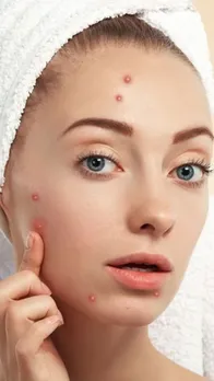 home remedies for Acne