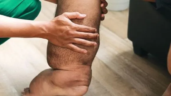 filariasis