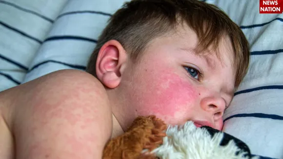  Measles