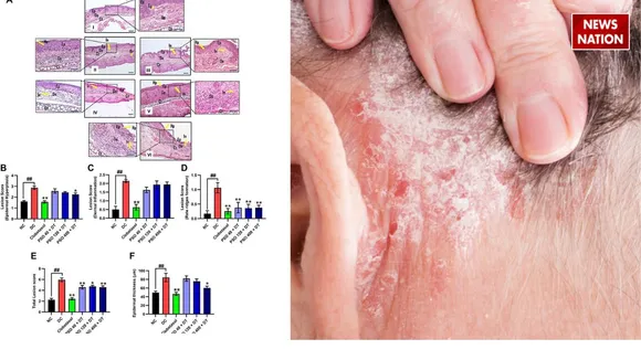 ayurvedic treatment for psoriasis,