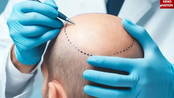 Hair Transplant