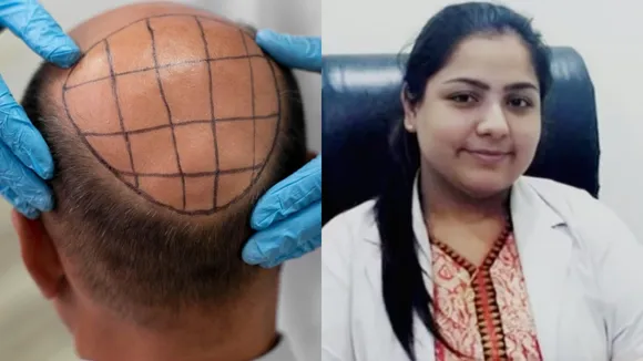 kanpur hair tansplant case
