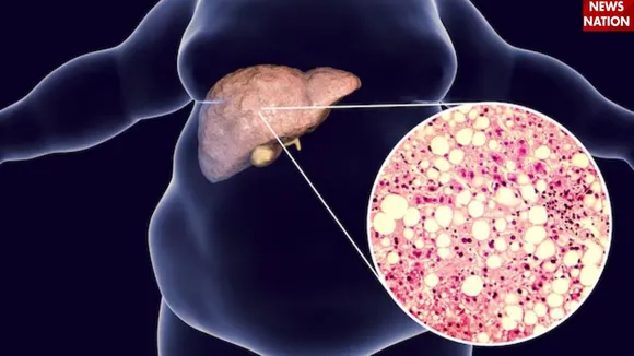 fatty liver