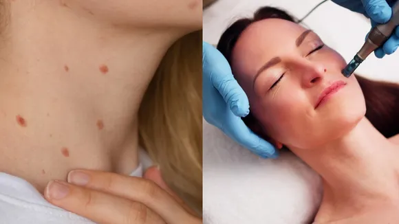 Home Remedies For Moles And Warts