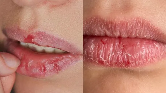 Dry Lips In Winter