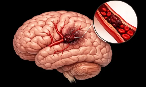 brain clot symptoms