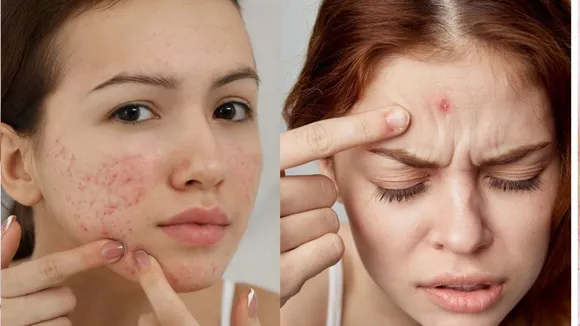 pimples 4