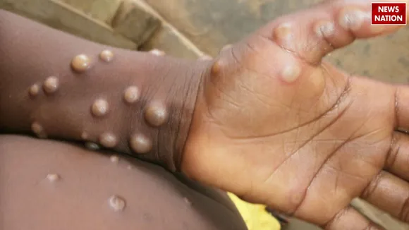 Mpox
