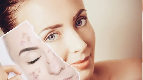 Acne Free Skin
