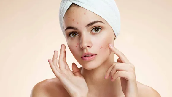 Problems of Pimples