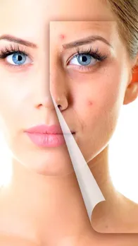 pimples 4