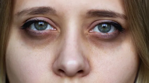 How to remove dark circles
