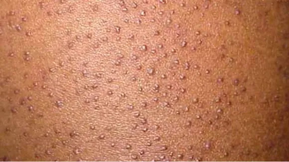 keratosis pilaris