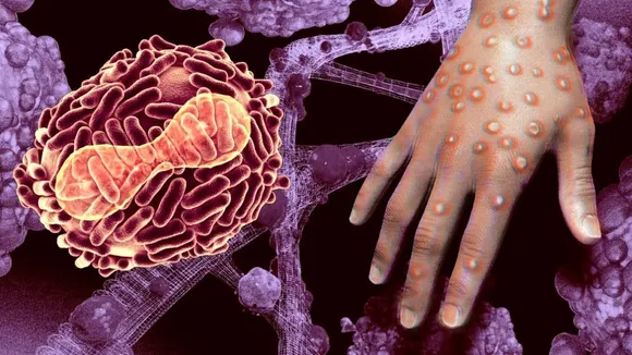 Monkey pox Virus