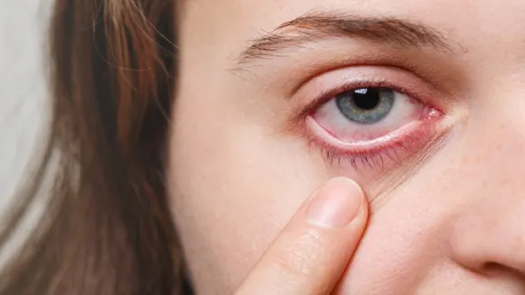 Dry Eyes
