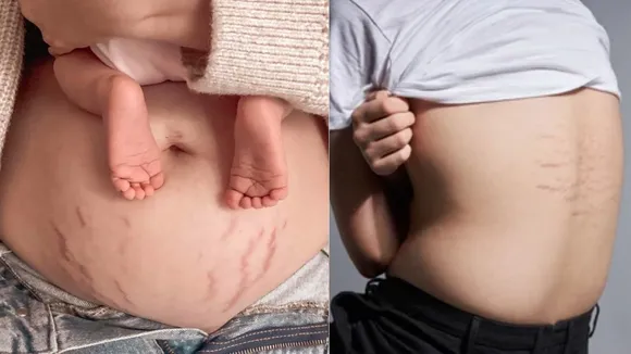 Stretch marks