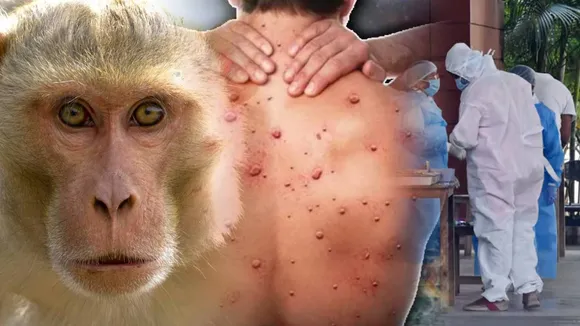 MonkeyPox 