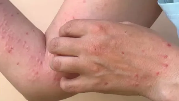 Monkeypox case