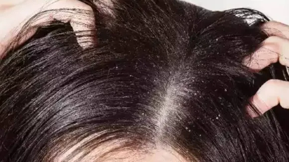 Can dandruff increase