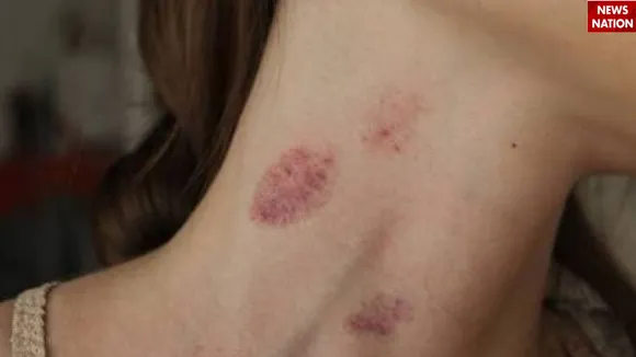 love bite (Social Media)