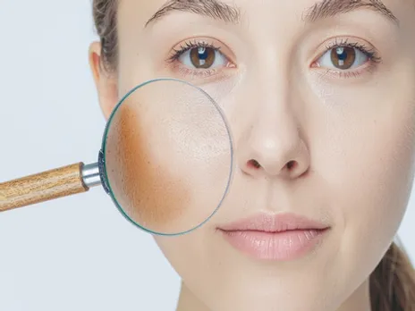 शरीर में विटामिन्स की कमी का संकेत है झाइयां, इन आयुर्वेदिक उपायों से मिल सकती है राहत।