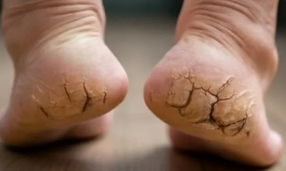 इस आयुर्वेदिक चीज से फटी एड़ियों से मिलेगा छुटकारा, फिर से बन सकती हैं मुलायम