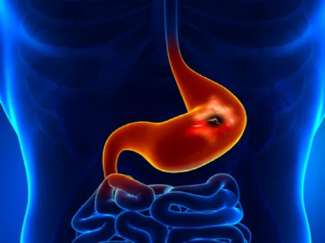 चुपचाप पेट में पैर पसारती है ये आंत से जुड़ी बीमारी, लक्षणों को न करें अनदेखा