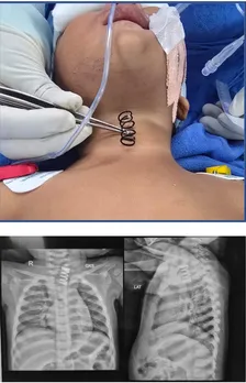 AIIMS doctors remove 2-inch-long metal spring from 14-month-old's food pipe