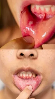 मुंह के छाले ठीक करेंगे ये 5 घरेलू उपाय!