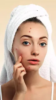 गर्मी में फोड़े-फुंसी से है परेशान, तो आजमाएं ये घरेलू उपाय