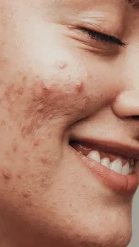 गर्मियों में न खाएं ये चीजें, हो जाएंगे पिंपल्स!