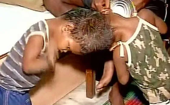 एम्स में चल रही है अनोखी सर्जरी, जानें कनजायंड ट्विन्स से जुड़ी मुख्य बातें