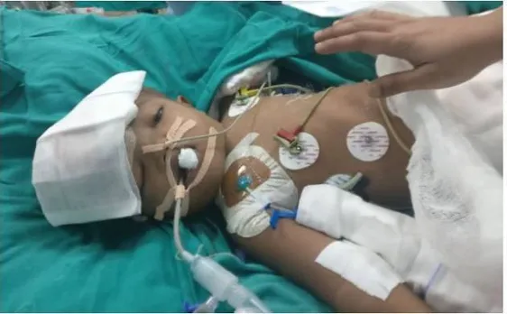 AIIMS: सर्जरी में सिर से जुड़े बच्चों को किया था अलग, 4 दिन बाद एक ने खोली आंखे