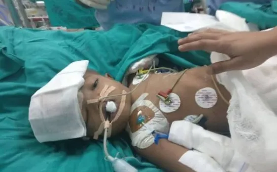 AIIMS: अलग हुए जुड़े सिर वाले कन्जाइंड ट्विंस में एक की हुई प्लास्टिक सर्जरी, हालत स्थिर