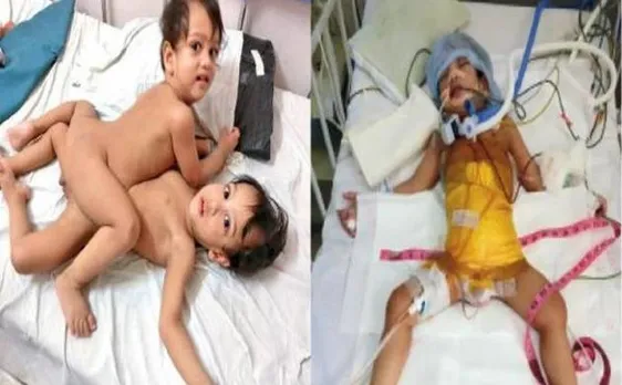 मुंबई: 12 घंटे चली सर्जरी से अलग किये गये लव और प्रिंस, कई अंग थे आपस में जुड़े