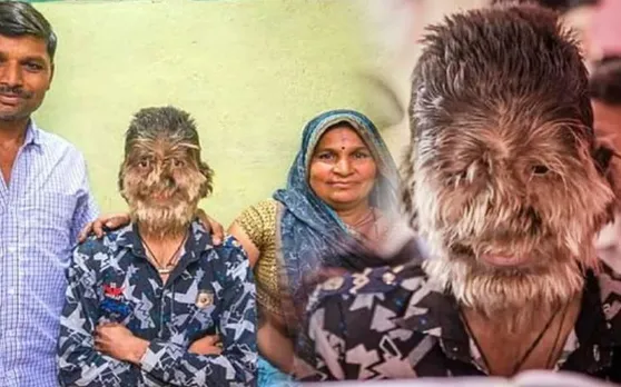 पूरे चेहरे पर उग आते हैं घने बाल, बच्चे ने गंभीर बीमारी के आगे कभी नहीं टेके घुटने, भावुक कर देगी कहानी