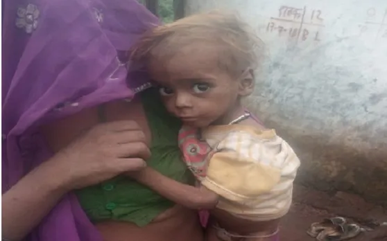 मध्य प्रदेश के श्योपुर में कुपोषण से 4 महीने के बच्चे की मौत