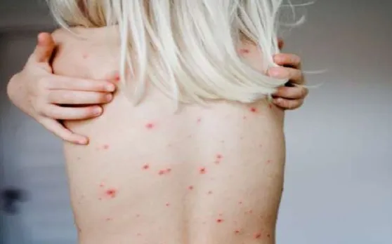 HIV से भी ज्यादा खतरनाक है ये बीमारी, यौन संक्रमण से फैलकर सुला रही मौत की नींद