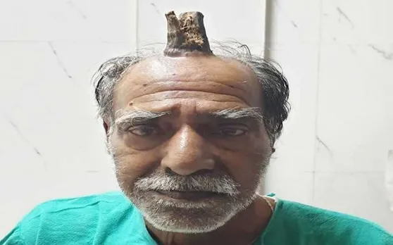 बुजुर्ग शख्स के सिर पर निकल आया सींग, डॉक्टर ने बताई ऐसी वजह.. पैरों तले खिसक जाएगी जमीन