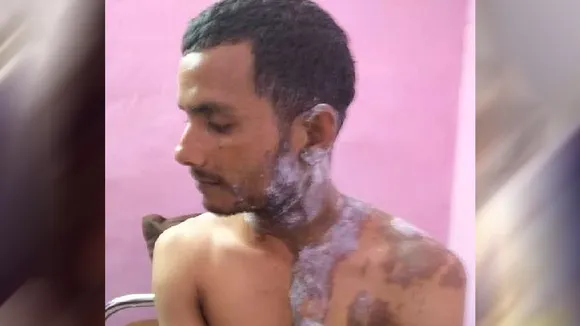 उन्नावः युवती ने एकतरफा प्यार में युवक पर फेंका तेजाब, लोग हैरान
