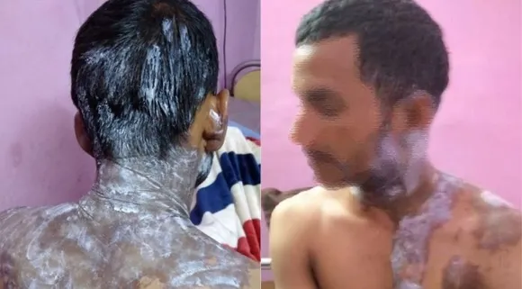 एकतरफा प्यार में मुस्लिम लड़की ने रोहित यादव पर किया तेजाब से हमला, 5 महीने से पड़ी थी पीछे