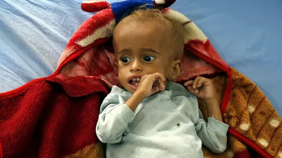 malnourished child