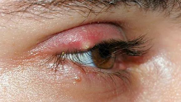 eye