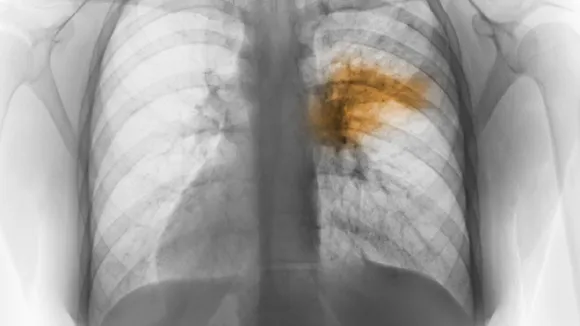 pneumonia new
