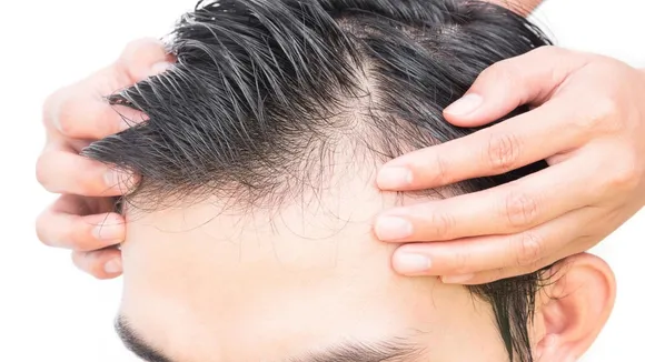 hair fall