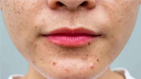 Pimples Problem