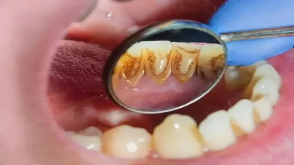 pyorrhea symptom