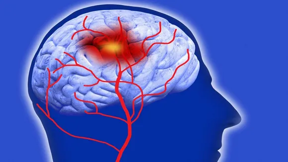 bad habits that increases brain stroke
