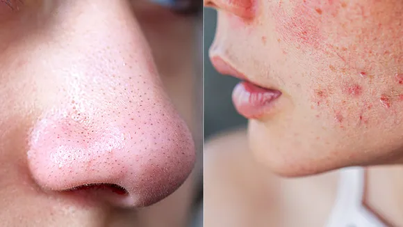 black heads removal home remedies
