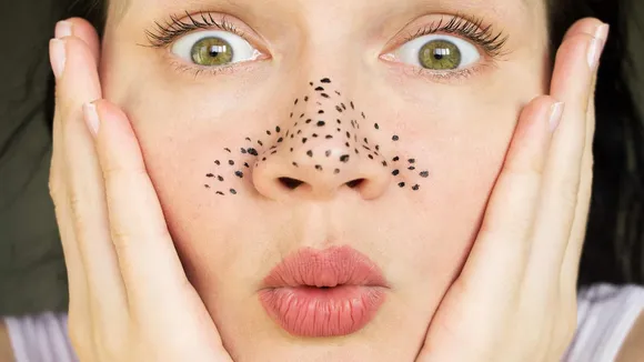 Blackheads